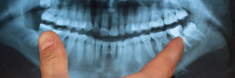 рентген зубов