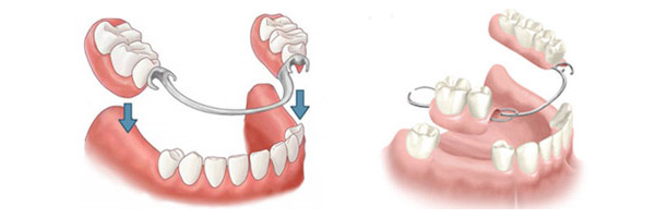 частично-съемные зубные протезы спб